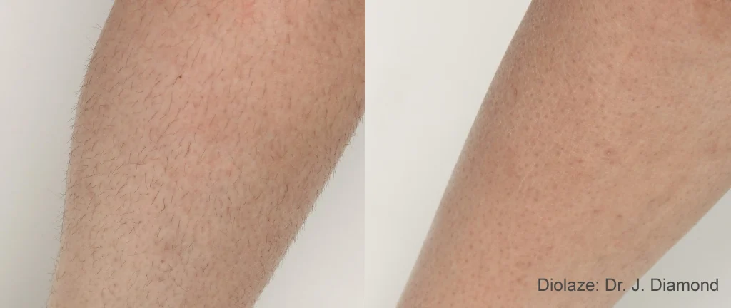 Laser Hair Removal image 1