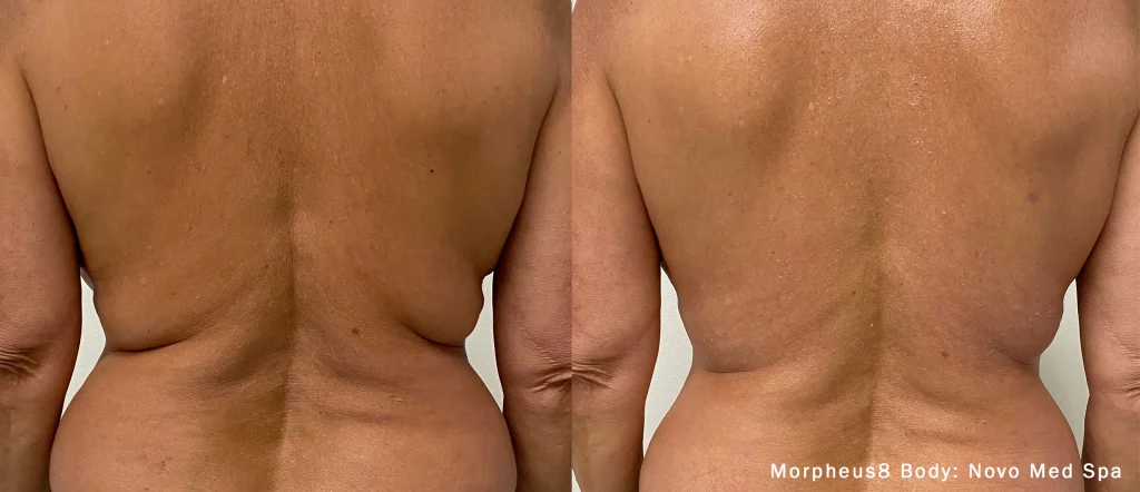 morpheus8 body before after novo medspa preview 1 4 1 morpheus8 m8 body contouring orlando